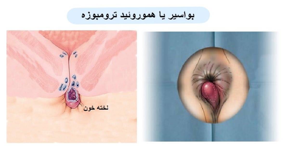 هموروئید ترومبوزه چیست عکس درمان و علائم بواسیر بادی درمان لیزر