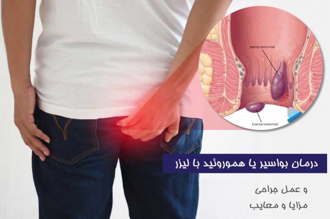 درمان بواسیر با لیزر و جراحی