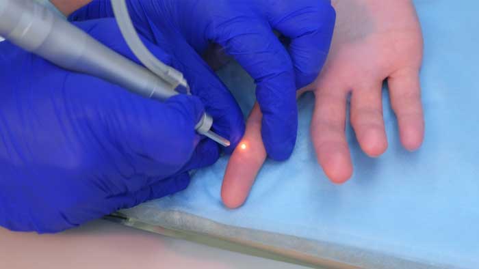 درمان زگیل دست با لیزر