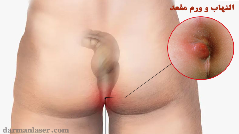 فیلم و عکس جراحی گوشت اضافه مقعدی