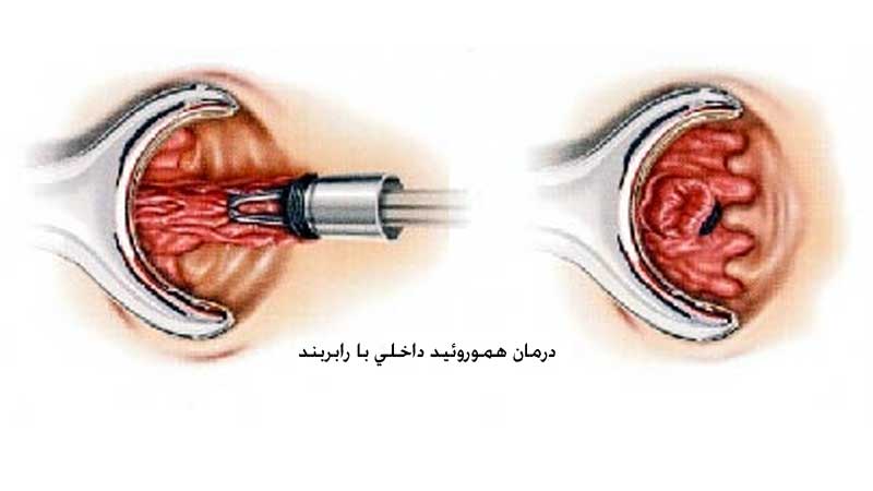 رابربند چیست و چگونه باعث درمان بواسیر یا هموروئید می شود؟