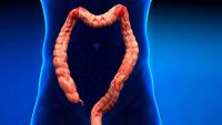 علت ابتلا به بیماری کولیت اولسراتیو چیست و چگونه می توان آن را درمان کرد؟