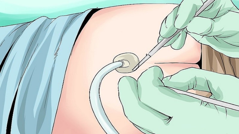 عمل جراحی کیست مویی یا سینوس پیلونیدال به روش باز و بسته