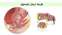 هزینه درمان فیستول با لیزر مقرون به صرفه تر نسبت به جراحی