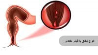 انواع شقاق مقعدی، تشخیص و عوامل تشدید شقاق حاد و مزمن