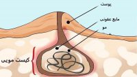 عکس کیست مویی یا سینوس پیلونیدال برای تشخیص به موقع بیماری