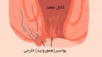درمان بواسیر خارجی بدون جراحی و هموروئید بیرون زدگی
