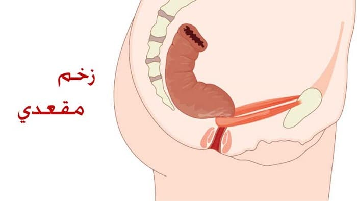 عکس زخم مقعد