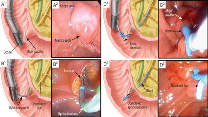اسفنکتروتومی شقاق