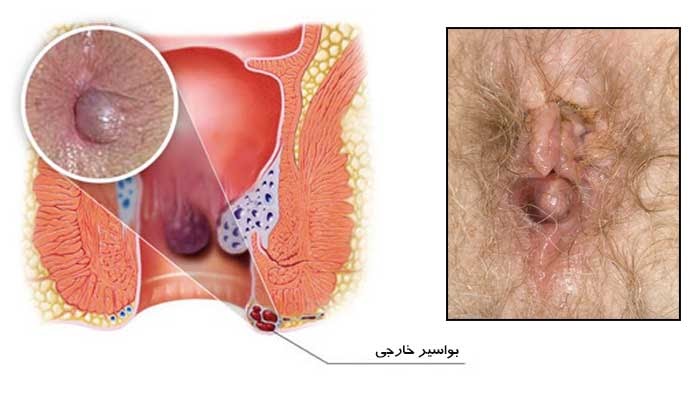 عکس بواسیر یا هموروئید خارجی