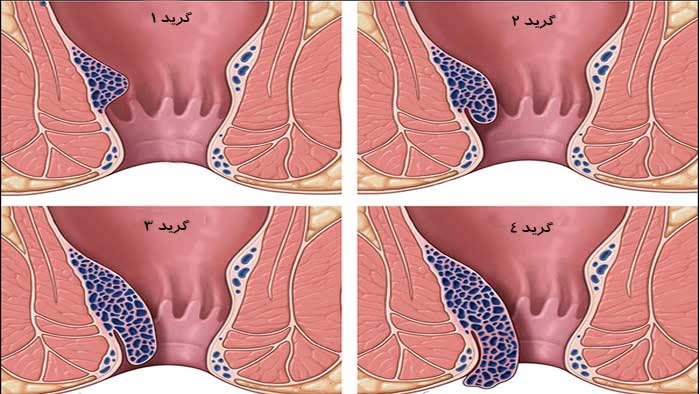 تصویر درجات مختلف هموروئید داخلی