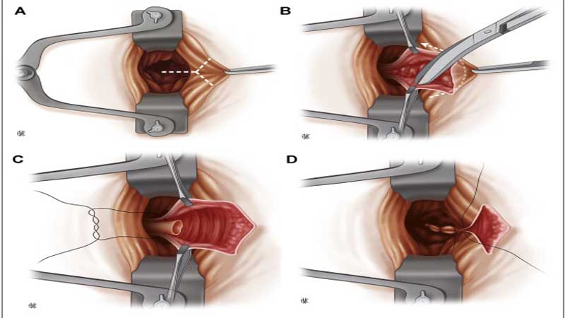 هموروئیدکتومی